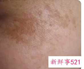 脸上的色斑是什么