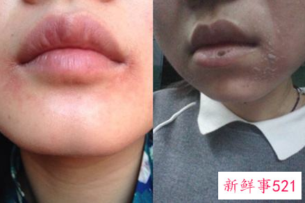 嘴角起皮擦什么