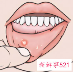 口腔溃疡怎么办怎么快速消除