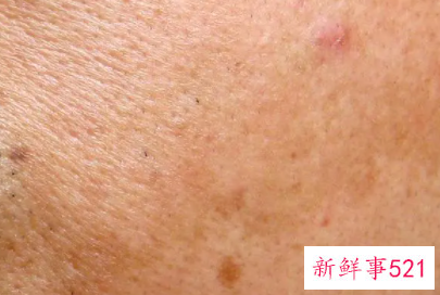 脸上晒出斑了怎么办