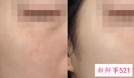 敏感肌会不会变成激素脸