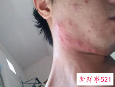 脸颊长痘痘是哪里的问题