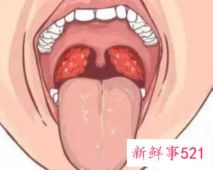 两岁小孩腺样体肥大怎么办