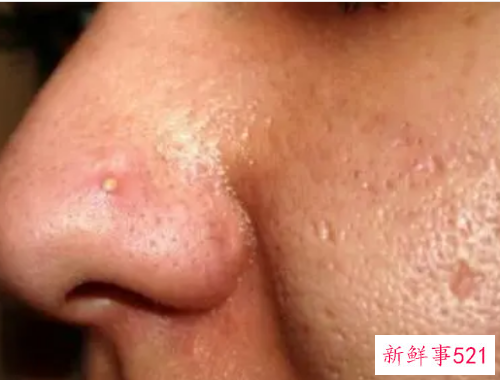 毛孔挤出黄颗粒