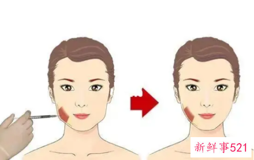 打瘦脸针几天能有效果