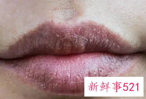 唇周围皮肤变黑是什么原因