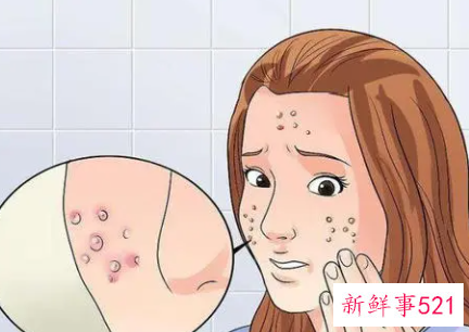 青春痘应该怎么去除