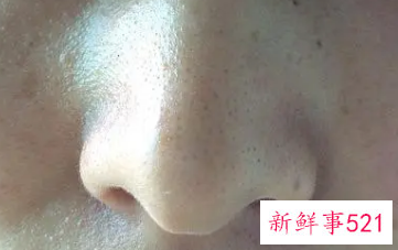 怎么清除鼻子上的黑头