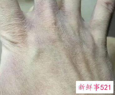 从小手就粗糙干燥皱纹多