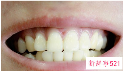 牙齿太黄了有什么办法弄白吗