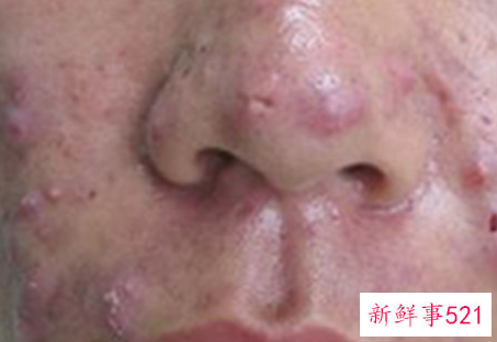 男生青春痘怎么才能消除