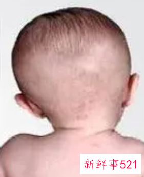 新生儿头歪向一侧