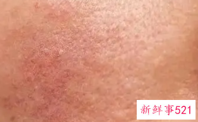 有红血丝就是敏感肌吗