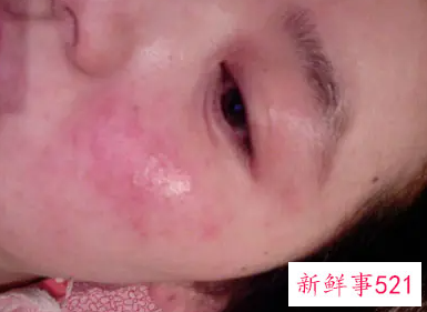 脸化妆品过敏怎么办