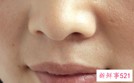 青春痘怎么消除