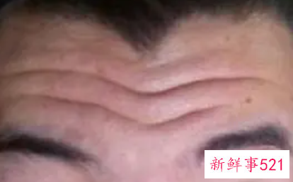 永久去抬头纹手术多少钱