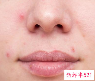 脸颊长痘痘是哪里的问题