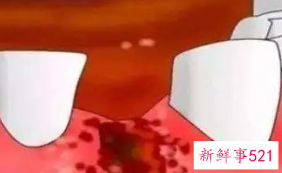 拔牙后该如何护理伤口