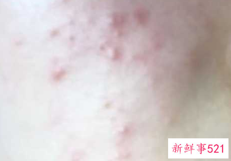 洗面奶洗脸后发红发烫