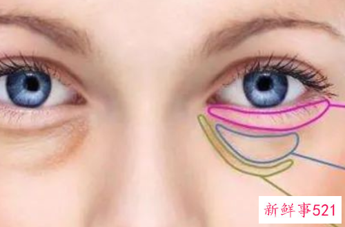 如何去除眼袋最有效