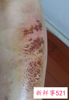 去除摔伤黑印的偏方