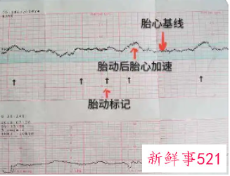 胎心监护图怎么看宫缩
