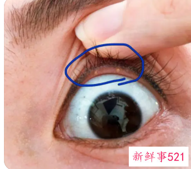 眼皮上的脂肪粒怎么去除