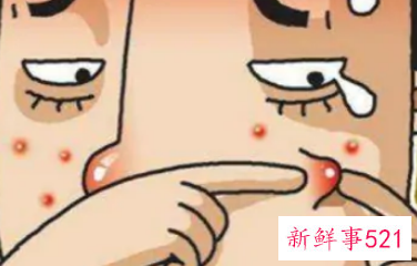 甲硝唑凝胶祛痘好用吗