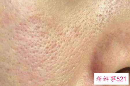 毛孔粗大是什么原因造成的呢