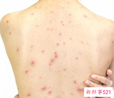 螨虫叮咬后的症状图