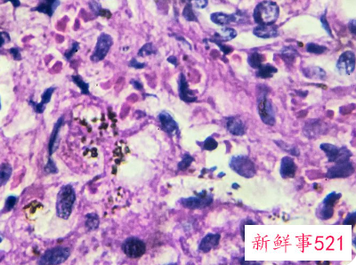 霉菌用手抠出来的图片