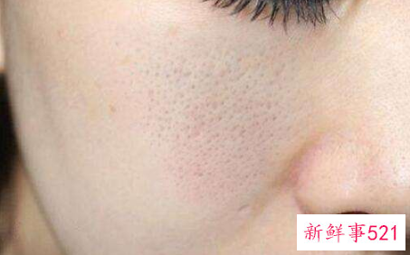 毛孔挤出黄颗粒