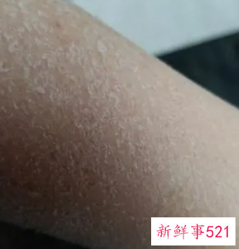 孕早期皮肤干燥脱皮