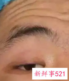 眼皮下垂怎么改善最有效