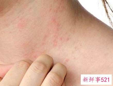 螨虫叮咬后的症状图