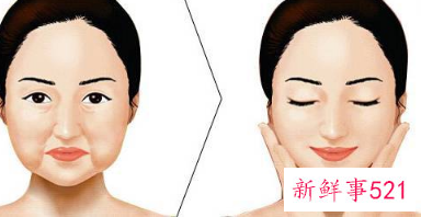 全脸脂肪填充案例