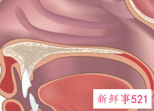 两岁小孩腺样体肥大怎么办