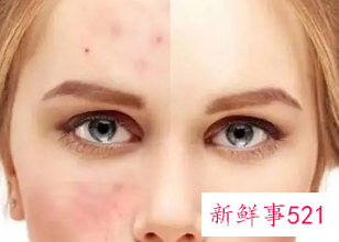 皮肤屏障受损如何治疗