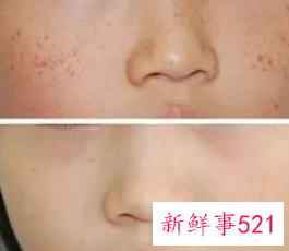 激光去色素沉着价格