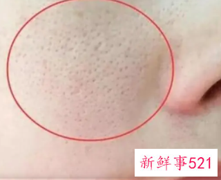 如何使毛孔粗大变小