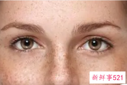 雀斑如何淡化雀斑小窍门