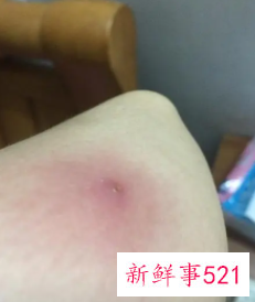 腿上肿了个包发红硬疼
