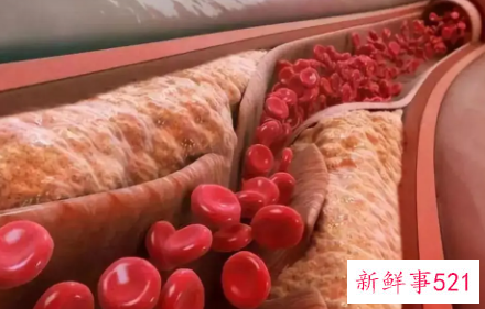 孕妇胆固醇偏高怎么办