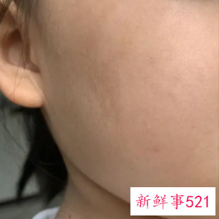 脸上晒出斑了怎么办