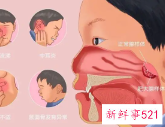 两岁小孩腺样体肥大怎么办