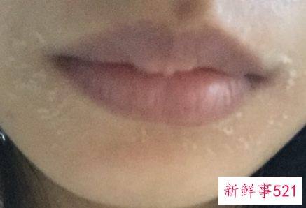 嘴角起皮擦什么