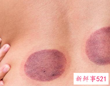 正确的拔罐方法