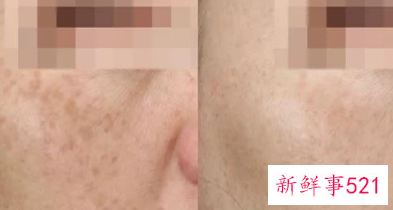 敏感肌会不会变成激素脸