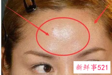 脸上出油严重是怎么回事