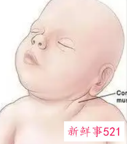 新生儿头歪向一侧